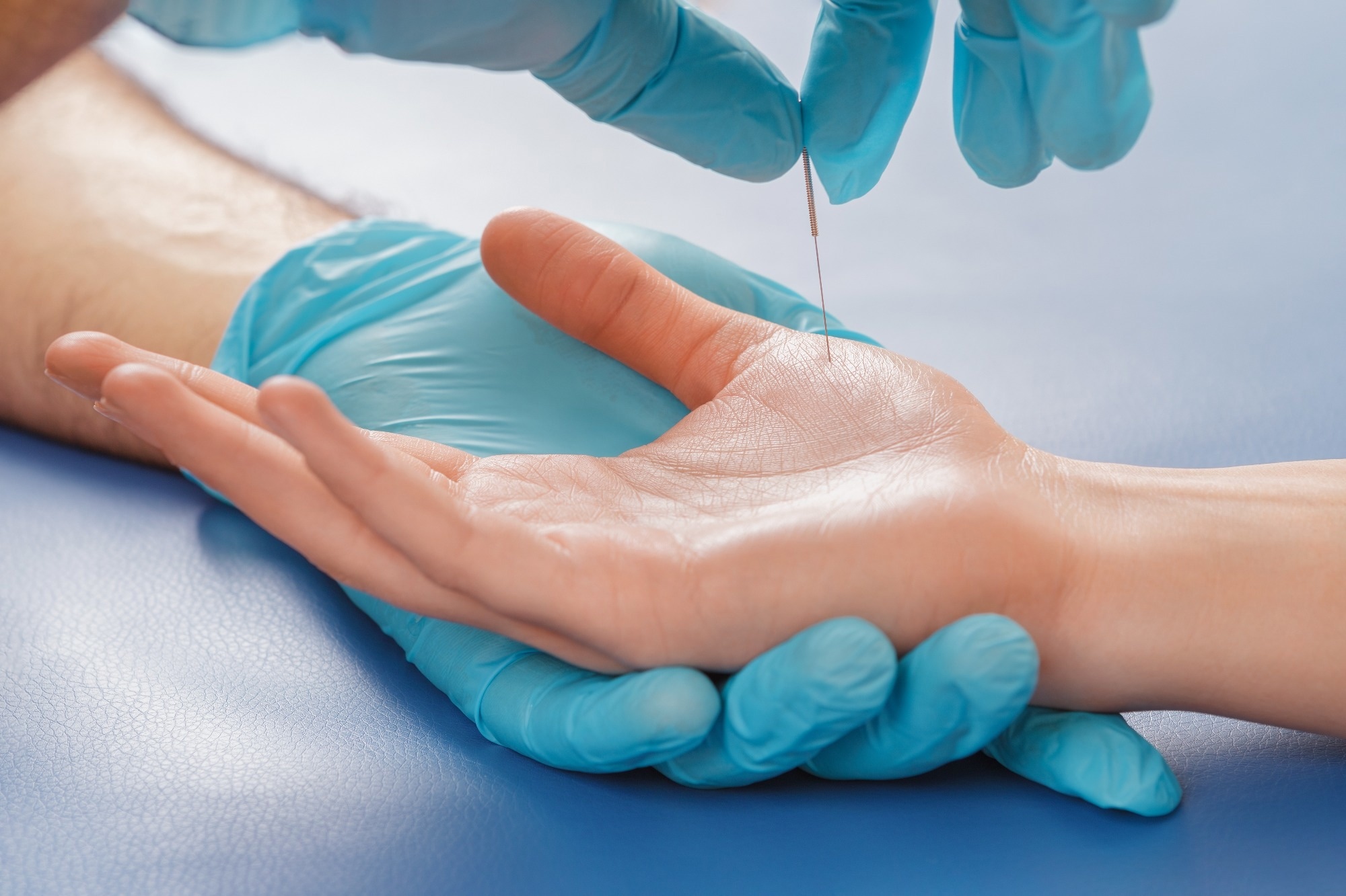 Acupuncture treatment on a patient