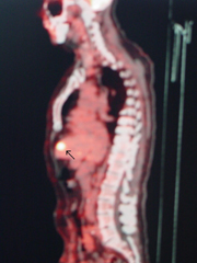 Positron Emission Tomography (PET) combined with Computerized Tomography (CT) imaging can assist in determining the extent and stage of tumors. PET/CT is also useful in assessing a cancer patient’s progress in a given treatment course.
