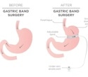 Study finds surge in the use of weight loss drugs among bariatric surgery patients