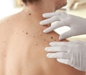 Study reveals how melanoma evolves to resist immunotherapy