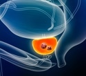 Shorter hormone therapy may be enough for many men with prostate cancer