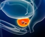 Rethinking prostate cancer risk in GG1 diagnoses