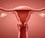 Modern pollutants and ancient genetic variants could explain why some women develop endometriosis
