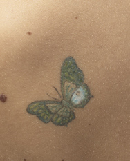 As tattoos have grown in popularity, so have complaints of adverse side effects associated with both their application and removal.